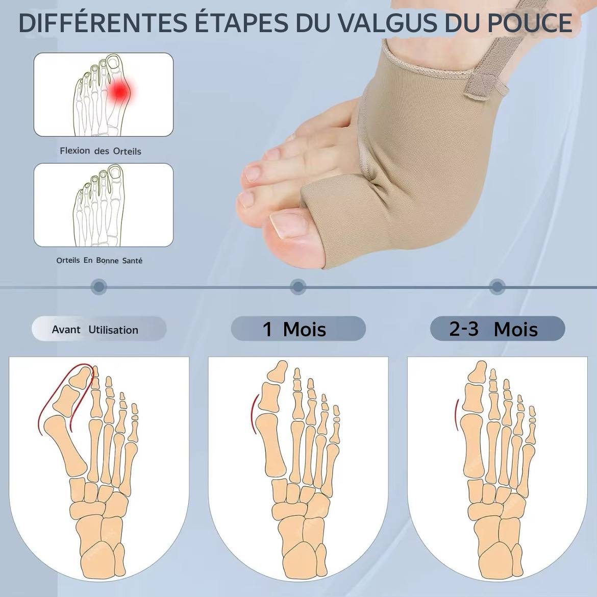 correcteur d’oignon (ou hallux valgus) 👣